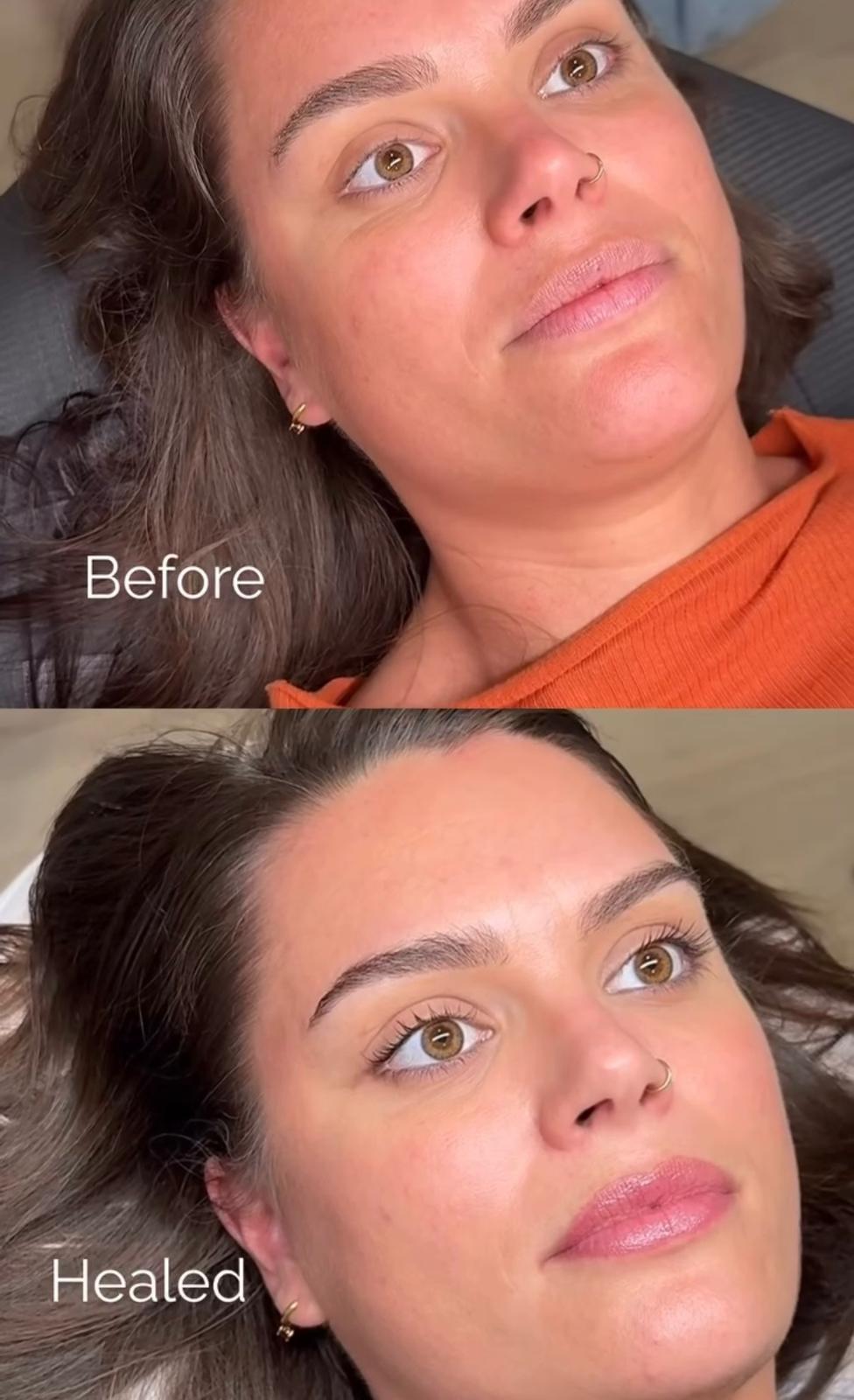 Brows before and healed at Berkem Brows