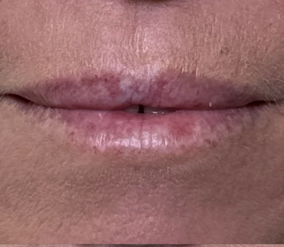 Lips before lip blush
