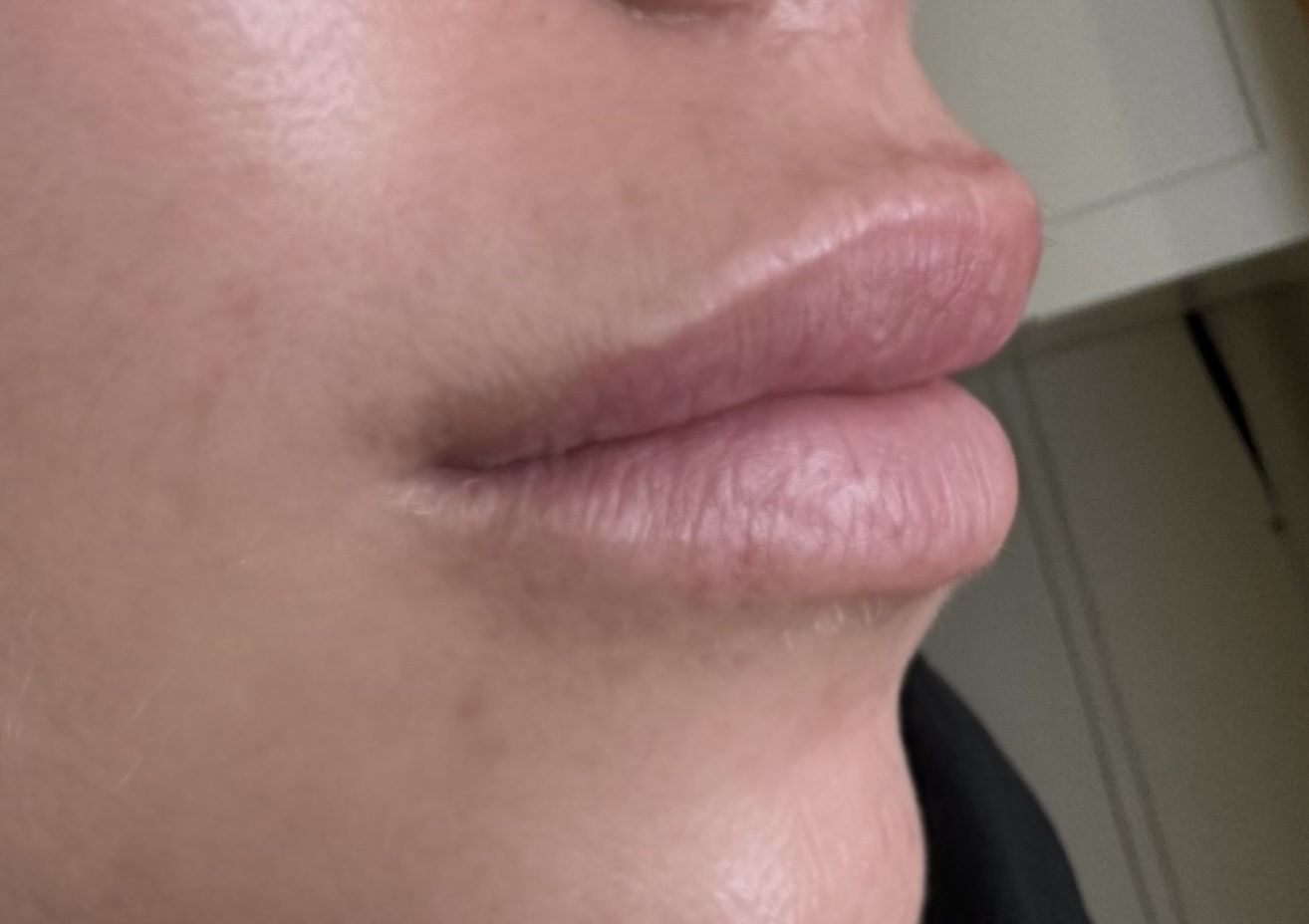 Lips before lip blush appointment